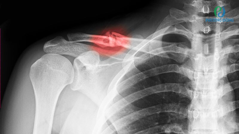 Gãy xương đòn có thể tháo nẹp sau 12 tháng điều trị
