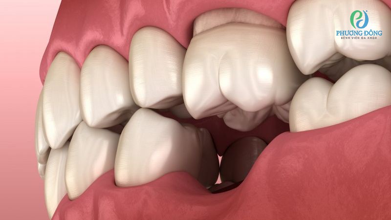 Mất răng bao lâu thì bị tiêu xương hàm?