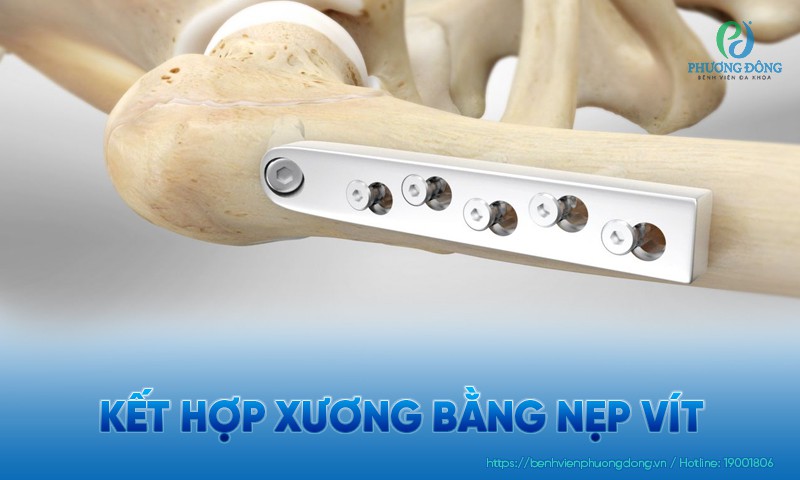 Kết hợp xương bằng nẹp vít là gì? Gợi ý lối sống và dinh dưỡng