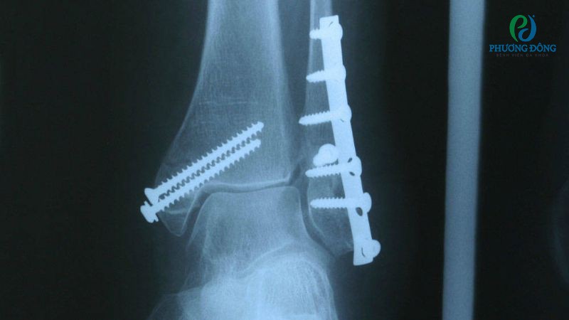 Kết hợp xương bằng nẹp vít giúp cố định hai đầu xương bị gãy