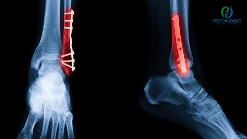 Một số hướng dẫn chăm sóc hậu kết hợp xương với nẹp vít