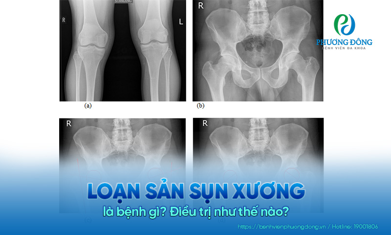 Loạn sản sụn xương là bệnh gì? Điều trị như thế nào?