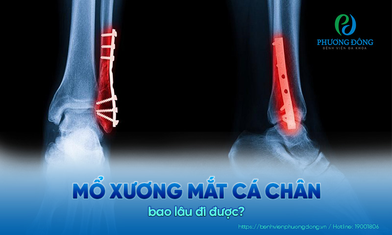 Mổ xương mắt cá chân bao lâu đi được?