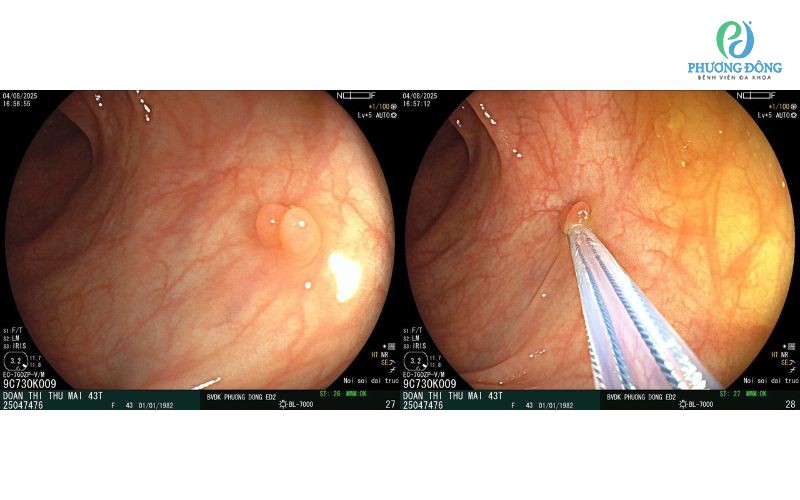 Đừng để một polyp hôm nay - Trở thành ung thư đại tràng ngày mai!