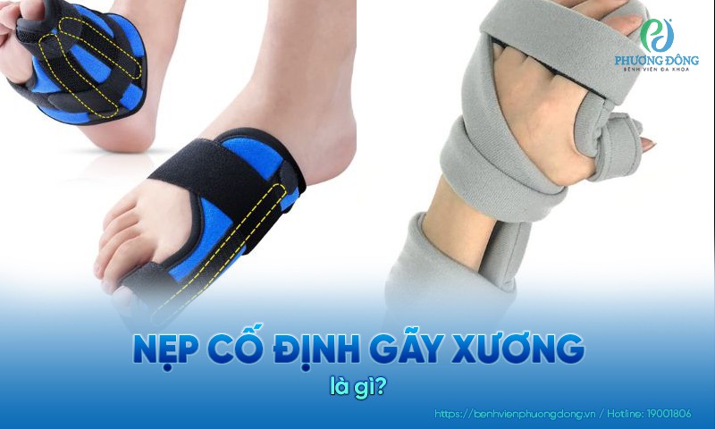 Nẹp cố định gãy xương là kỹ thuật cố định một phần xương bị gãy