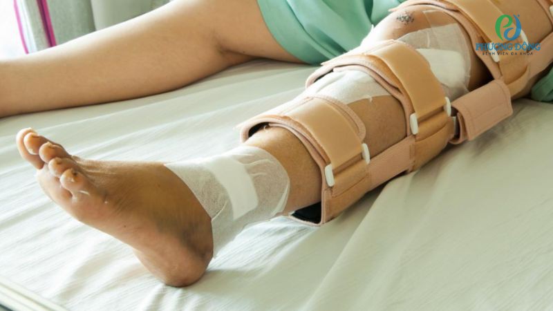Phương pháp nẹp cố định gãy xương cẳng chân