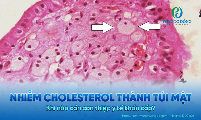 Nhiễm cholesterol thành túi mật: Khi nào cần can thiệp y tế khẩn cấp?