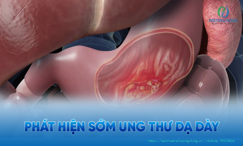 Phát hiện sớm ung thư dạ dày bằng cách khám sức khỏe định kỳ