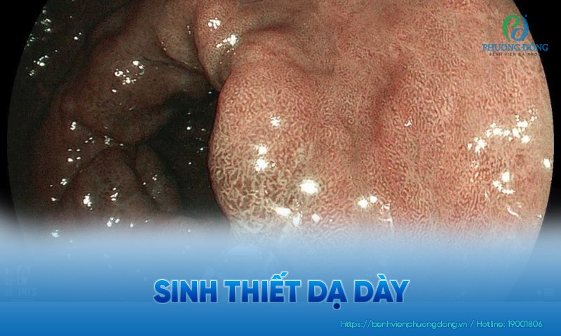 Sinh thiết dạ dày là gì? Những điều cần biết trước khi thực hiện