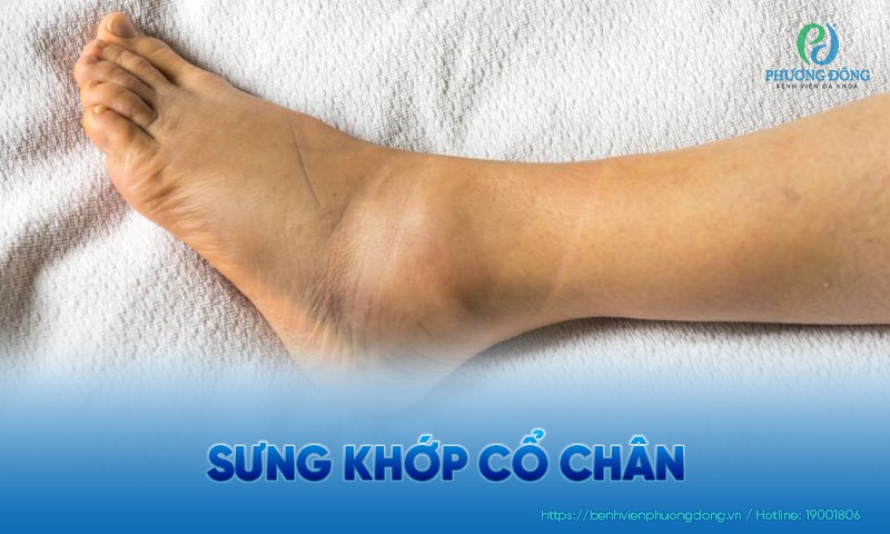 Sưng khớp cổ chân: Nguyên nhân, triệu chứng và điều trị
