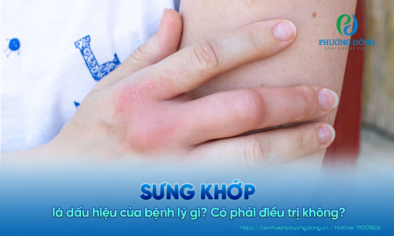 Sưng khớp là dấu hiệu của bệnh lý gì? Có phải điều trị không?