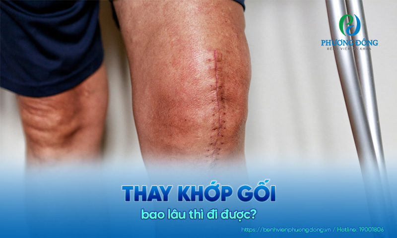 Thay khớp gối bao lâu thì đi được?