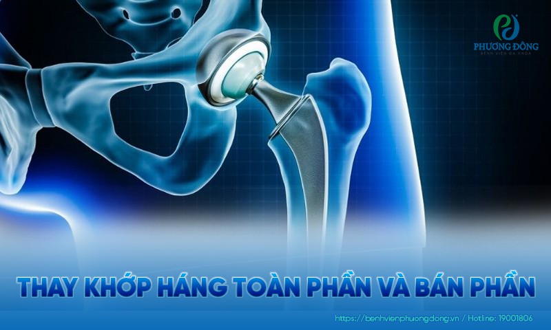Thay khớp háng toàn phần và bán phần: Chỉ định và biến chứng