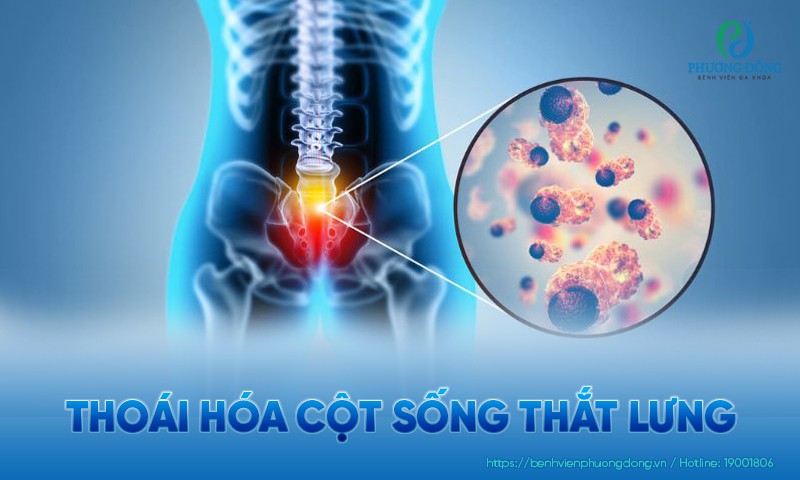 Thoái hóa cột sống thắt lưng: Nguyên nhân, triệu chứng và hướng điều trị