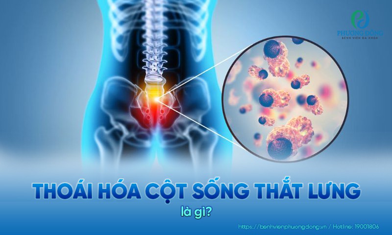 Thoái hoá cột sống thắt lưng phổ biến ở người trung niên và cao tuổi