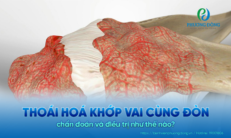 Thoái hoá khớp cùng vai đòn chẩn đoán và điều trị như thế nào?