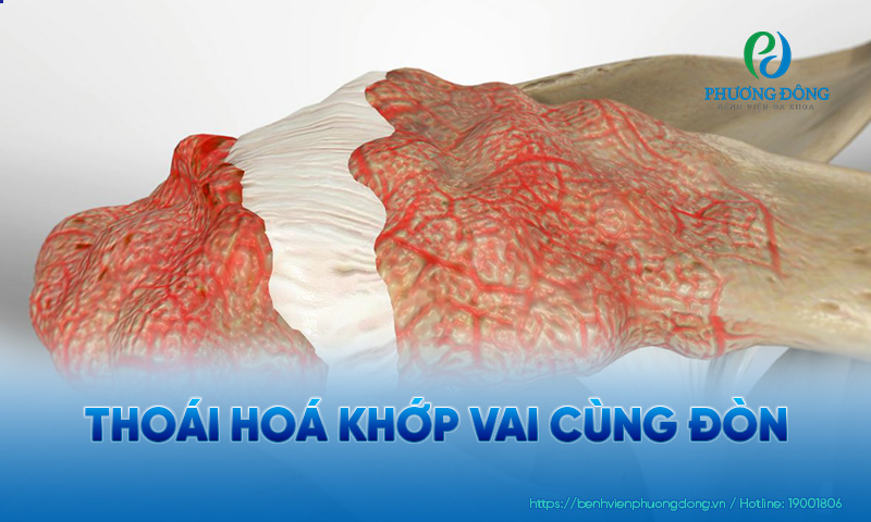 Đây là bệnh đi kèm với tình trạng viêm nhiễm tại khớp