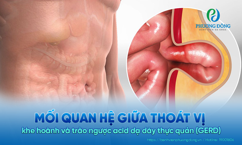 Mối quan hệ giữa thoát vị khe hoành và trào ngược acid dạ dày thực quản (GERD)