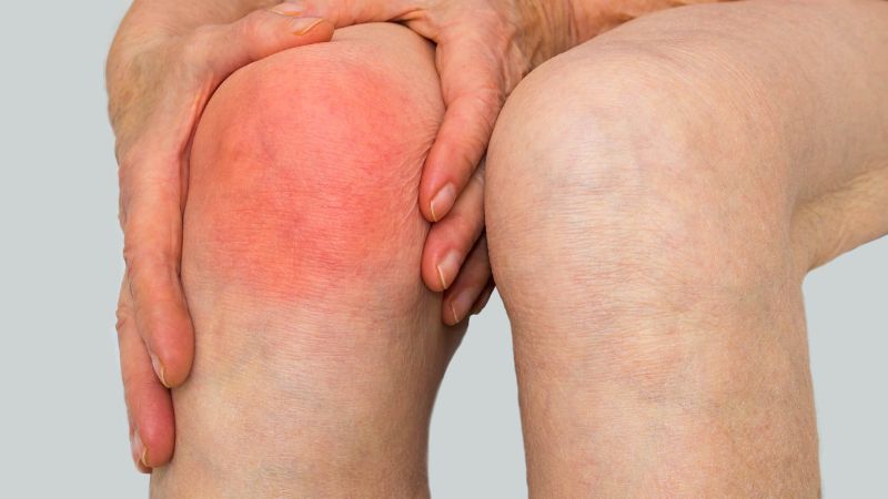 Người bị viêm khớp nhiễm khuẩn không được thực hiện thủ thuật này