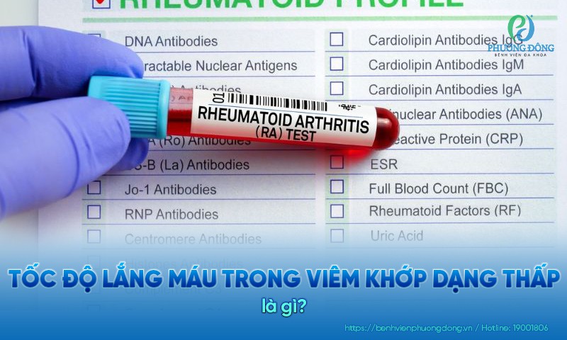 Xét nghiệm tốc độ máu lắng trong viêm khớp dạng thấp