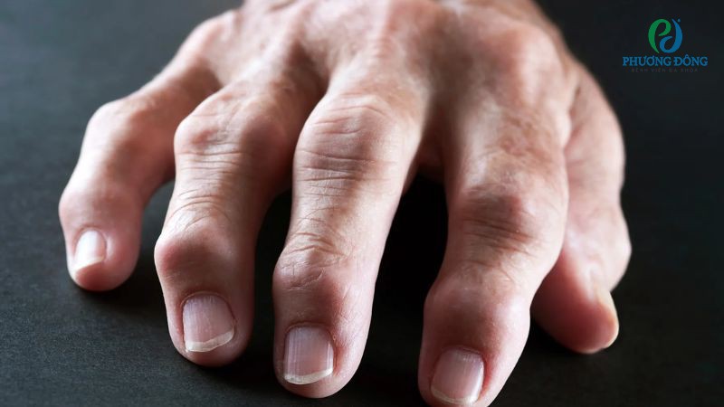 Những trường hợp nghi ngờ viêm khớp dạng thấp