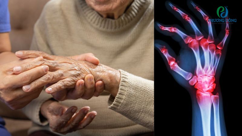 Các phương pháp bổ trợ chẩn đoán viêm khớp dạng thấp
