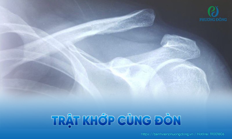 Trật khớp cùng đòn: Triệu chứng, nguyên nhân và điều trị