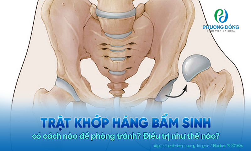 Trật khớp háng bẩm sinh có cách nào để phòng tránh? Điều trị như thế nào?