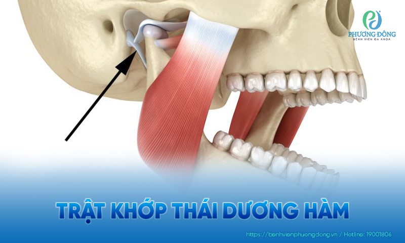 Trật khớp thái dương hàm: Nguyên nhân, triệu chứng và điều trị