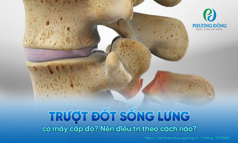 Trượt đốt sống lưng có mấy cấp độ? Nên điều trị theo cách nào?
