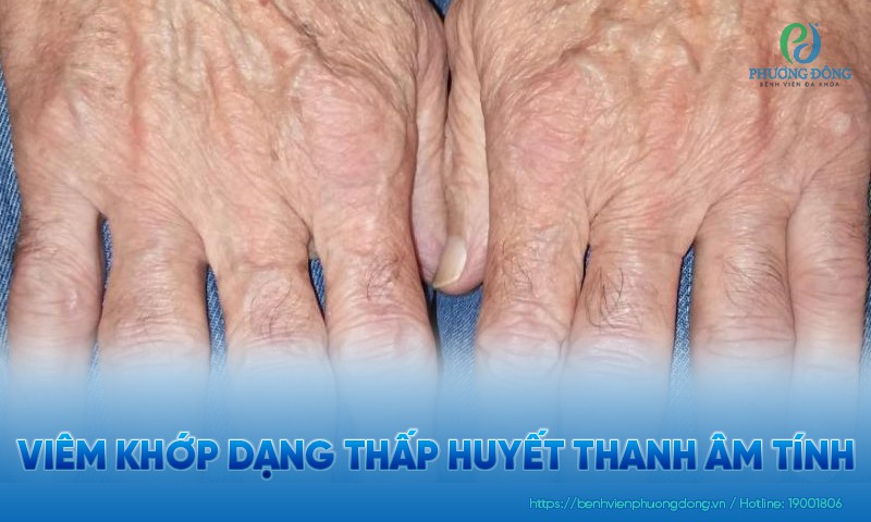 Viêm khớp dạng thấp huyết thanh âm tính: Triệu chứng, nguyên nhân và điều trị