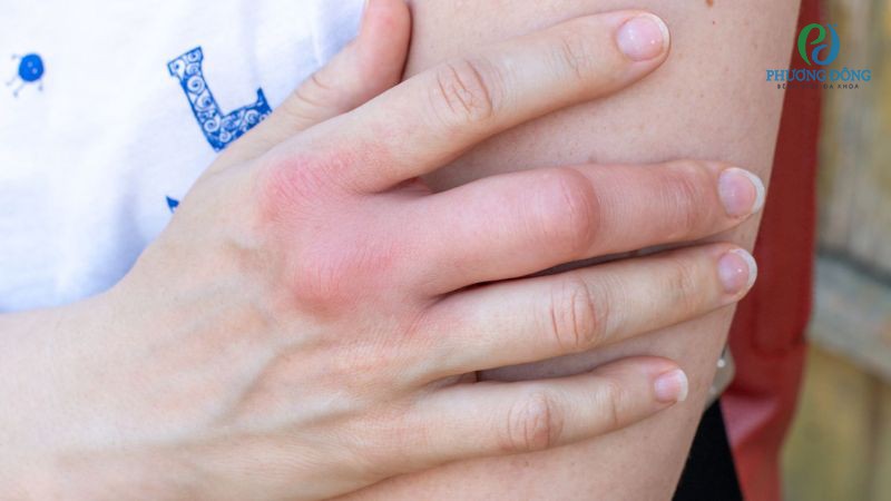 Biểu hiện lâm sàng của viêm khớp dạng thấp thể âm tính