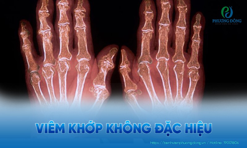 Viêm khớp không đặc hiệu: Nguyên nhân, triệu chứng và cách điều trị