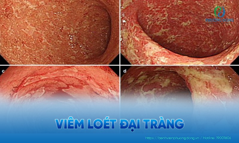Viêm loét đại tràng (ULCERATIVE COLITIS – UC) là gì?