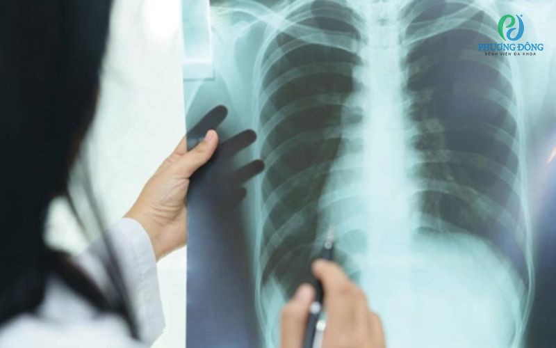 Viêm phổi cấp: Nguyên nhân, triệu chứng và cách điều trị bệnh