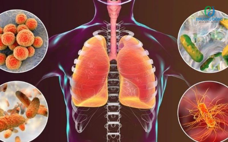 Viêm phổi cộng đồng: Nguyên nhân, triệu chứng và cách điều trị bệnh