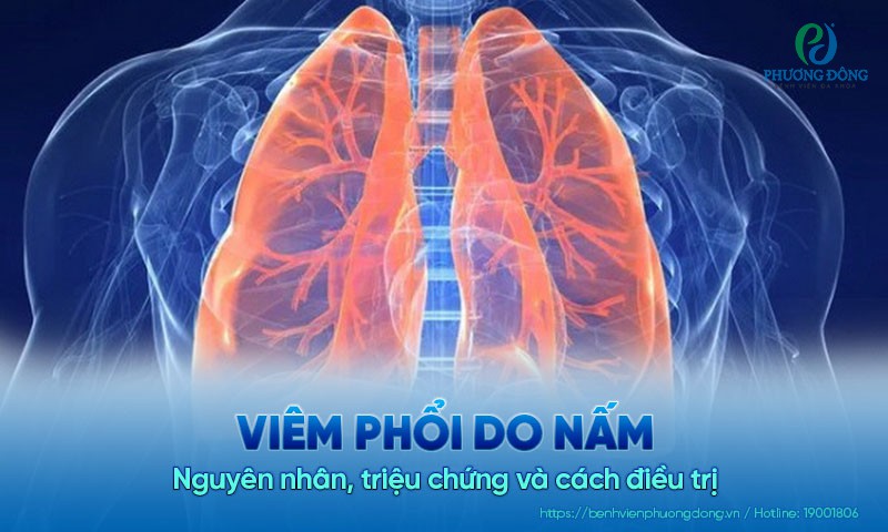 Viêm phổi do nấm: Nguyên nhân, triệu chứng và cách điều trị