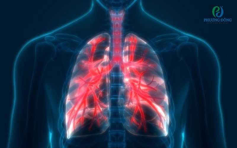 Viêm phổi mãn tính: Nguyên nhân, triệu chứng và cách điều trị bệnh