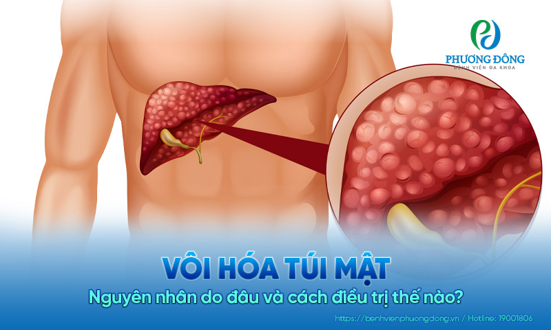 Vôi hóa túi mật nguyên nhân do đâu và cách điều trị thế nào?