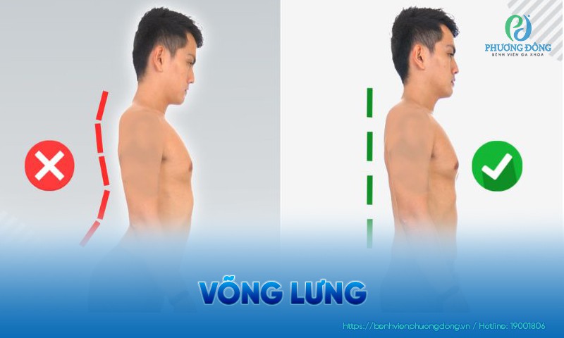 Võng lưng: Nguyên nhân và các phương pháp điều trị