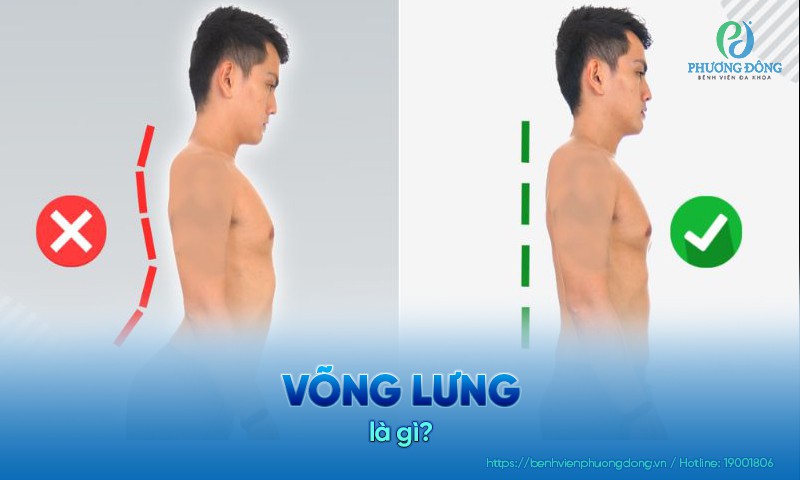 Võng lưng là một dạng rối loạn cột sống thắt lưng