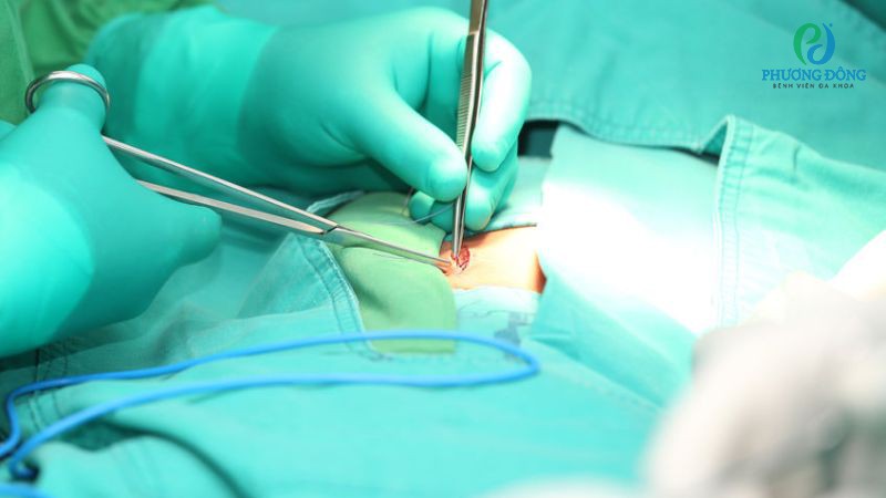 Hậu phẫu cắt cung sau cột sống có thể làm thay đổi cấu trúc tự nhiên xương lưng