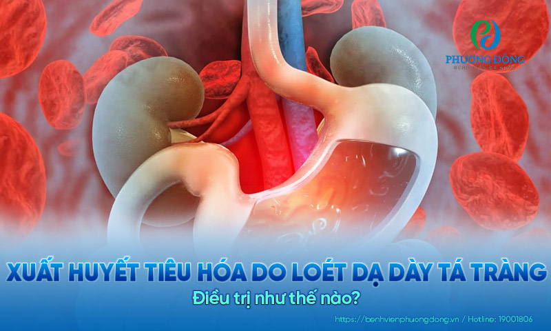 Xuất huyết tiêu hóa do loét dạ dày tá tràng điều trị như thế nào?