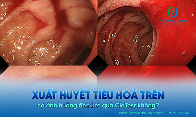 Xuất huyết tiêu hoá trên có ảnh hưởng đến kết quả CloTest không?