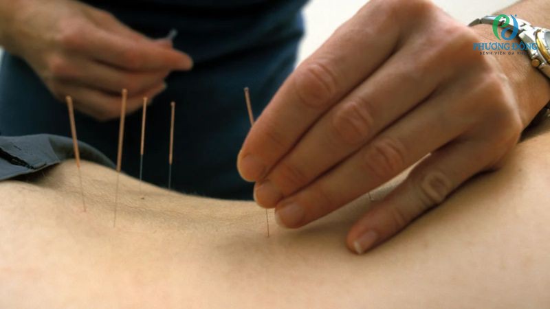 Bệnh nhân thoái hóa cột sống có thể châm cứu tại cơ sở y tế chuyên môn