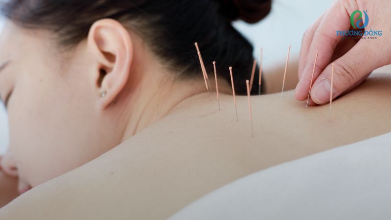 Bác sĩ trả lời: Thoái hóa cột sống có châm cứu được không? Bác sĩ trả lời: Thoái hóa cột sống có châm cứu được không?