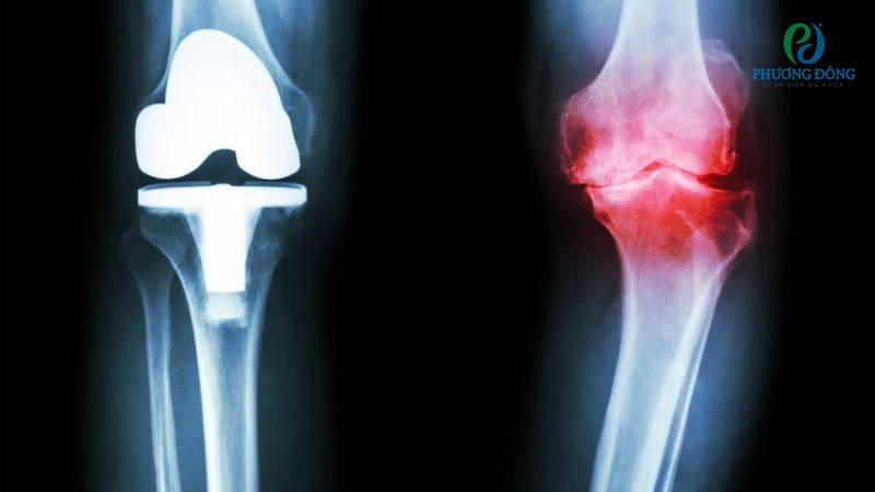 Thoái hóa khớp gối có thể điều trị nội khoa hoặc ngoại khoa nhưng không thể dứt điểm bệnh