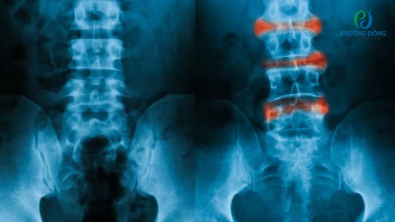 Tuổi thọ người bệnh viêm cột sống dính khớp bị ảnh hưởng bởi yếu tố chăm sóc, phương pháp điều trị và sức khỏe tinh thần