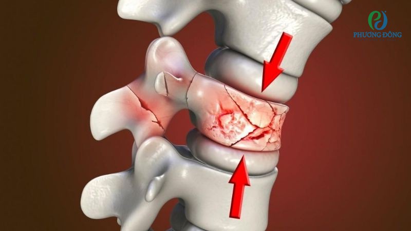Gãy cột sống kèm theo tổn thương tủy sống có tỷ lệ liệt chi hoặc toàn thân cao