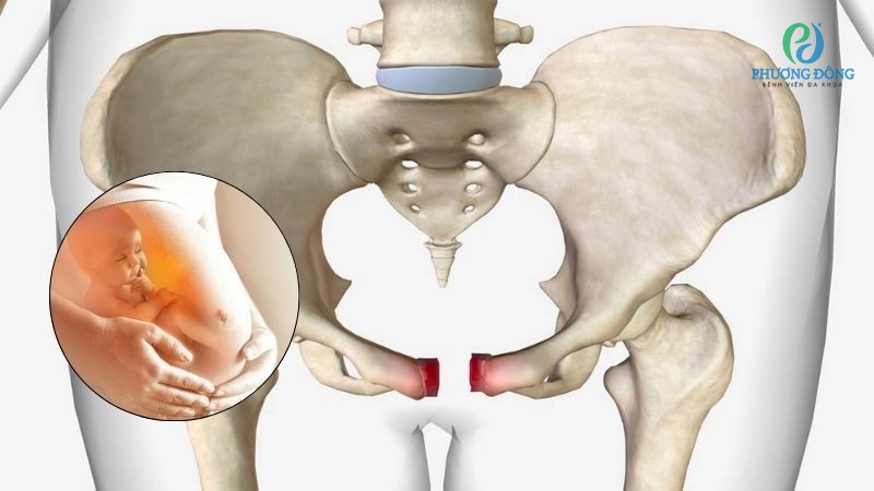 Bác sĩ Cơ Xương Khớp giải đáp: Gãy xương chậu có mang thai được không?